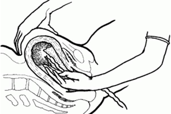 Khi phát hiện ra sót rau, cần nhanh chóng tiến hành thủ thuật kiểm soát tử cung